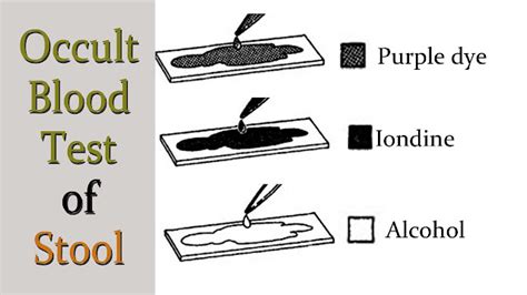 An Evaluation of the Benzidine Test for Occult Blood in the Feces.
